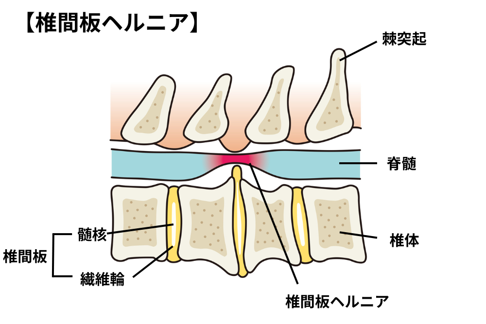 椎間板ヘルニアの図解